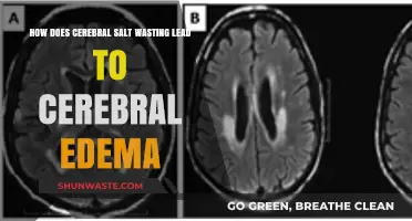 Cerebral Salt Wasting: Unraveling Its Role in Causing Cerebral Edema