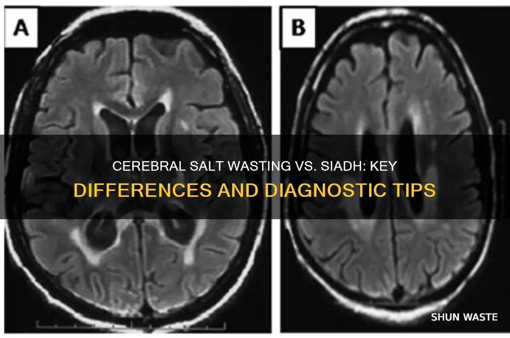 how to differentiate between cerebral salt wasting and siadh