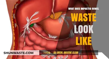 Understanding Impacted Bowel Waste: A Visual Guide