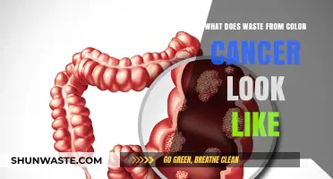 Understanding Colon Cancer: A Guide to Recognizing Waste Symptoms
